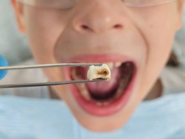 Best Chipped Tooth Repair Near Me  in Dover Beaches North, NJ